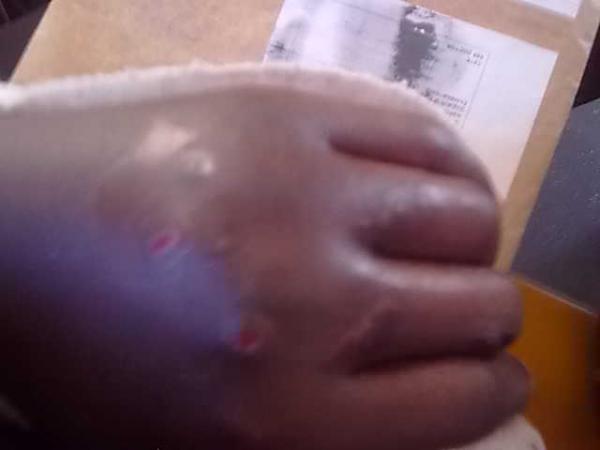 Chawasema's injured hand.