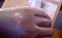 Chawasema's injured hand.