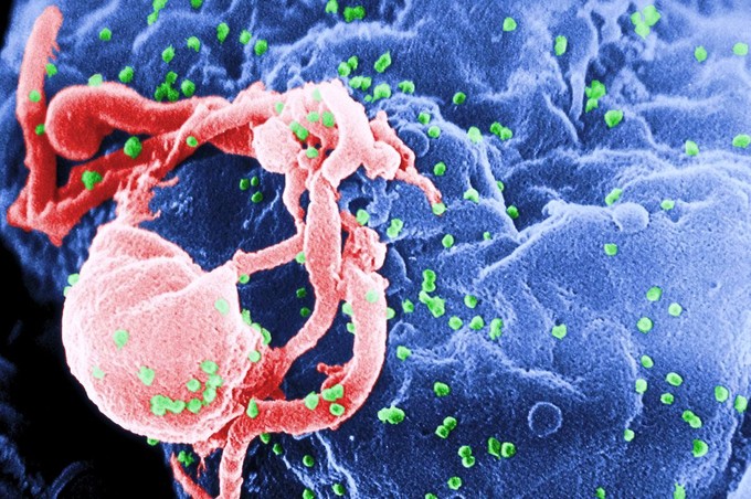 An electron micrograph of the HIV virus