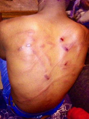 Photo of a man's scarred and bleeding back